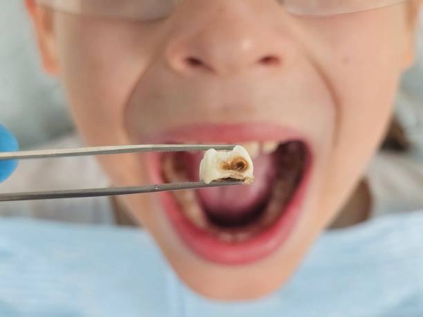 Best Emergency Treatment for Dental Infections or Abscesses in Wanamassa, NJ